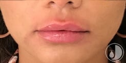 woman with lip filler