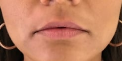woman before lip filler