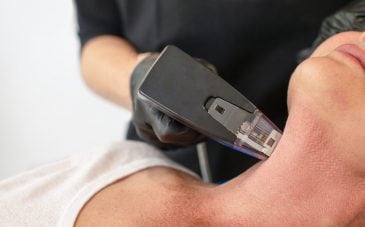 A specialist administering microneedling services to a client.