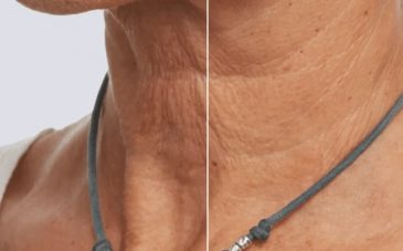 PRX before and after_Neck (1)