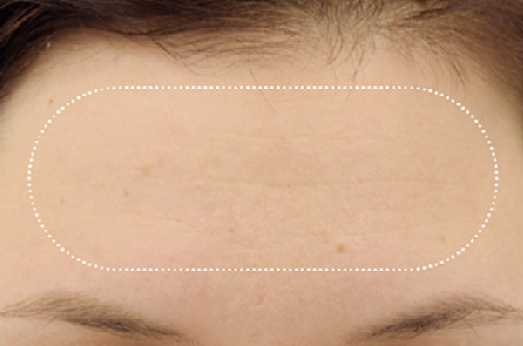 woman forehead