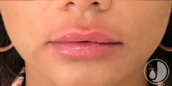 woman with lip filler